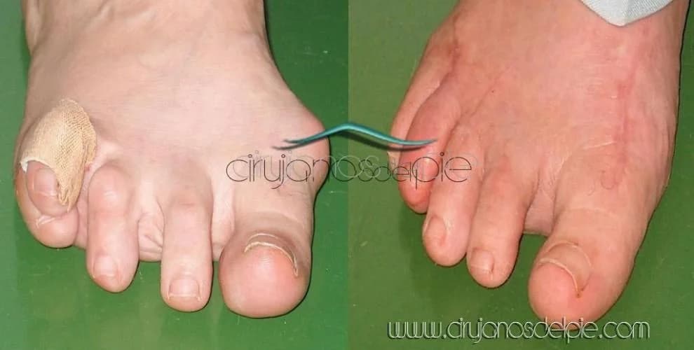 Artritis Reumatoide - Caso 1