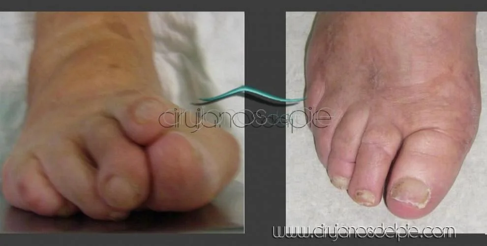 Artritis Reumatoide - Caso 2